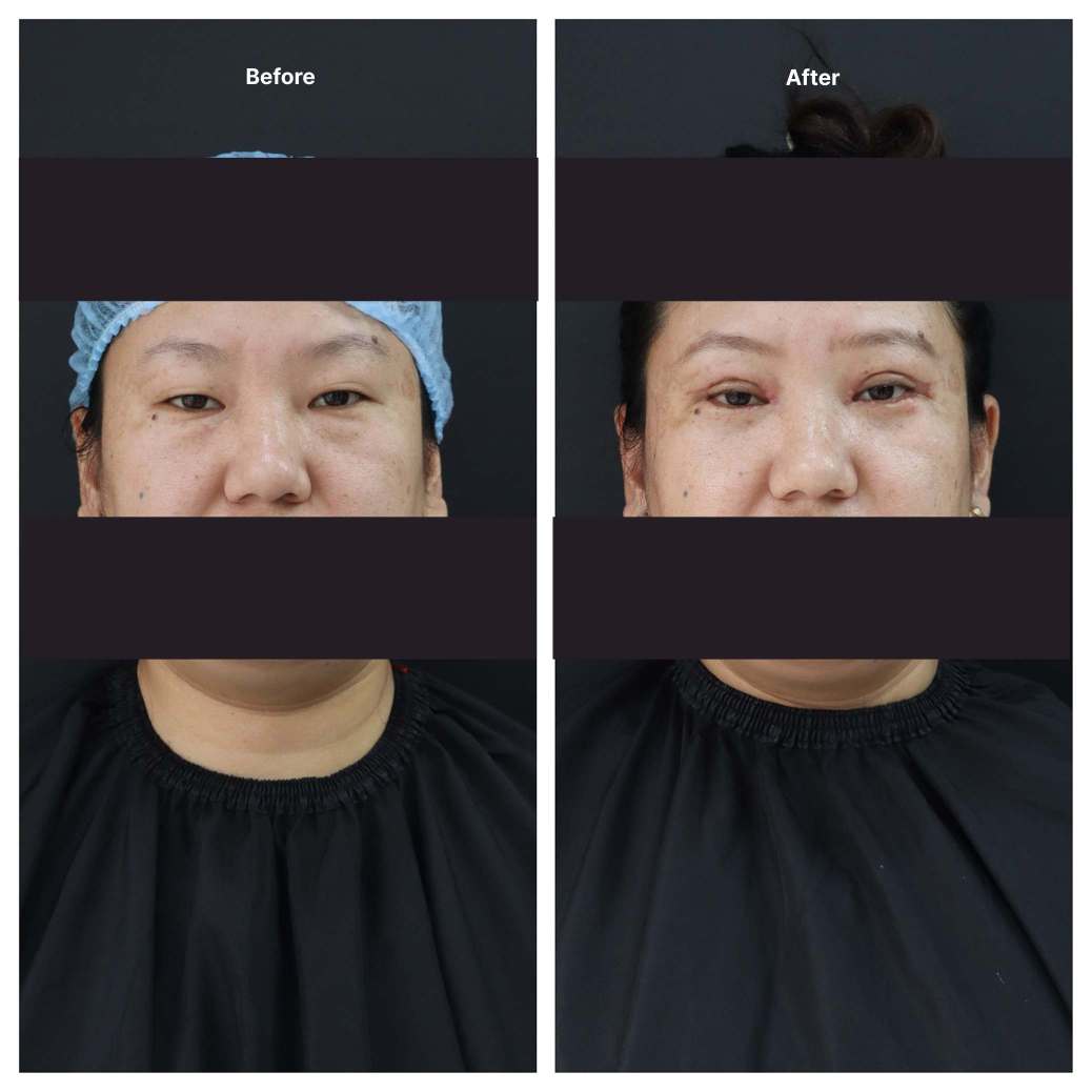 Eyelid Surgery KOQ10